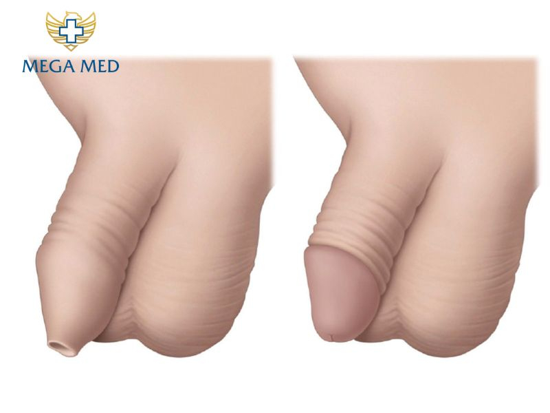 bao quy đầu sưng sau khi lột